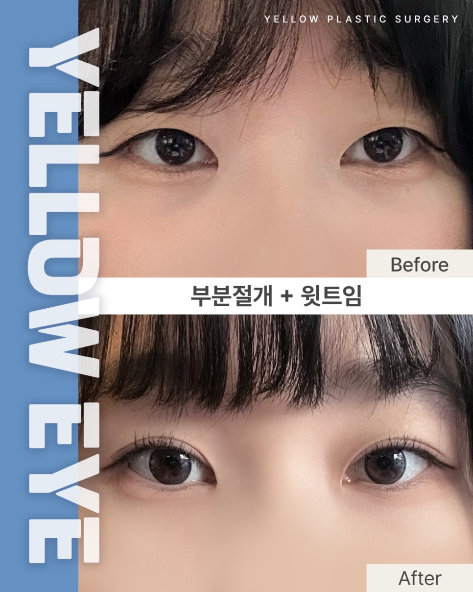[ 강남역 옐로우성형외과 / 눈성형 ] 부분절개 + 윗트임 관련 이미지 1