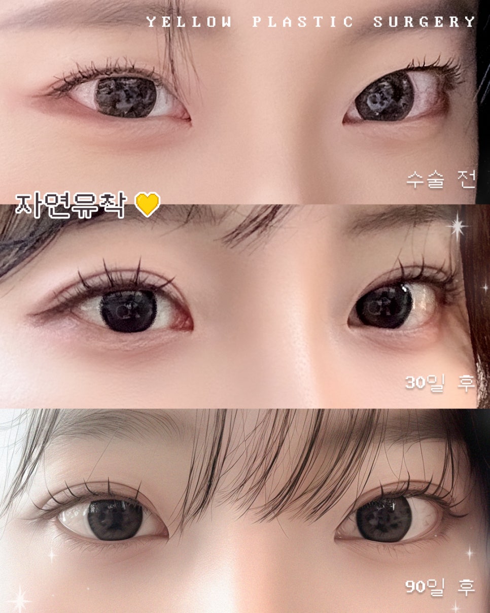[ Gangnam Station Yellow Plastic Surgery / Eye Surgery ] Natural Adhesion image 1