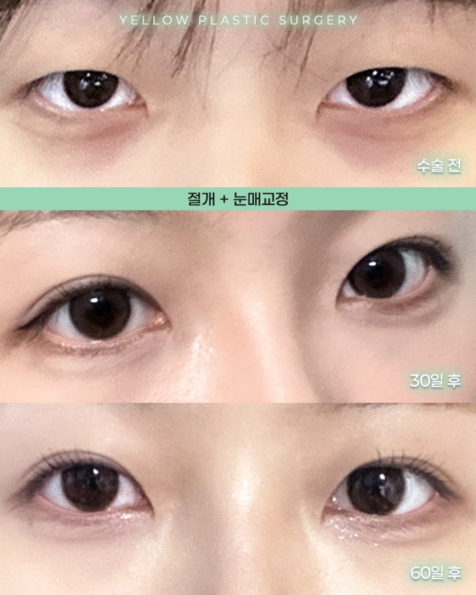 [ 강남역 옐로우성형외과 / 눈성형 ] 절개 + 눈매교정 관련 이미지 1