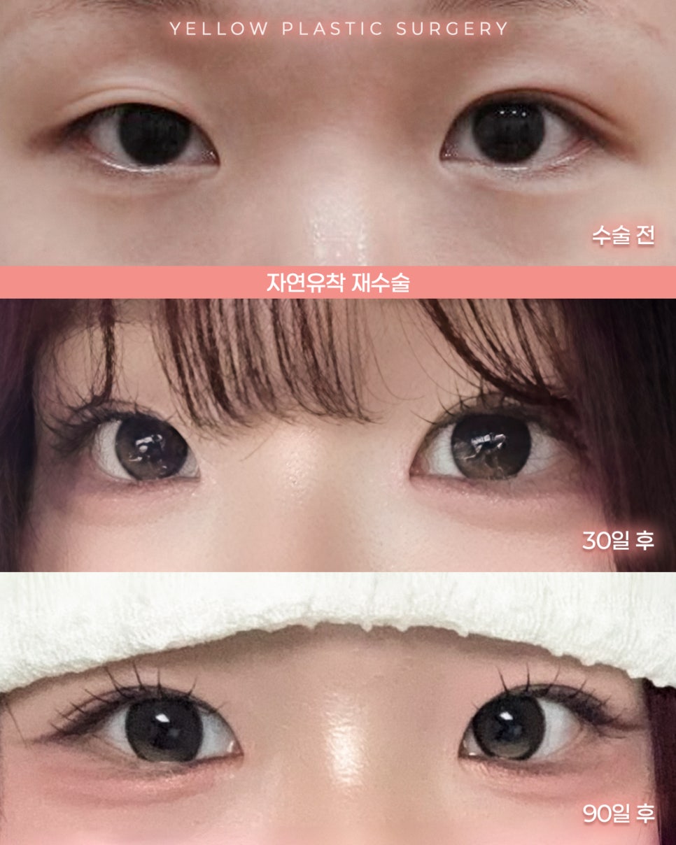[ 강남역 옐로우성형외과 / 눈성형 ] 자연유착 재수술 관련 이미지 1
