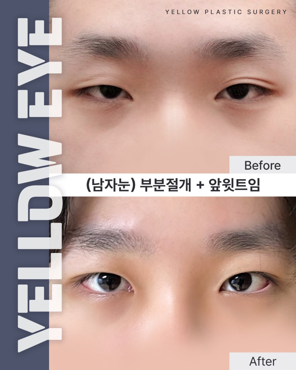 [ 강남역 옐로우성형외과 / 눈성형 ] (남자눈) 부분절개 + 앞윗트임 관련 이미지 1