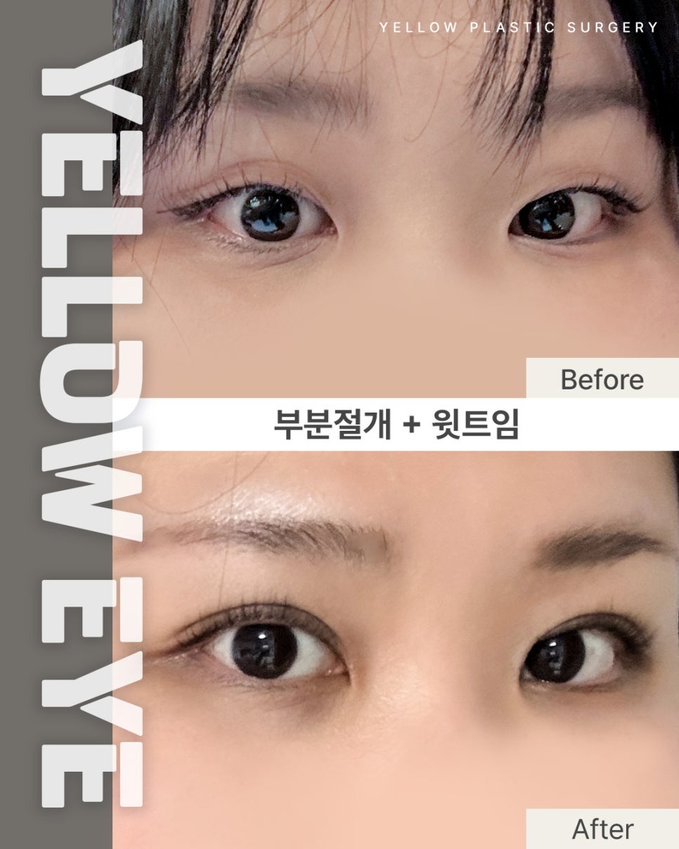 [ Gangnam Station Yellow Plastic Surgery Clinic / Eye Surgery ] Partial Incision + Upper Canthoplasty image 1