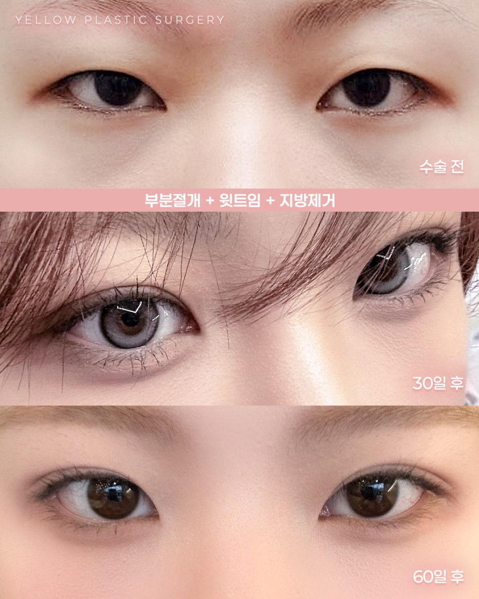 [ 강남역 옐로우성형외과 / 눈성형 ] 부분절개 + 윗트임 + 지방제거 관련 이미지 1