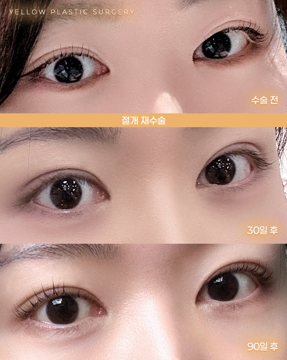 [ 강남역 옐로우성형외과 / 눈성형 ] 절개 재수술 관련 이미지 1