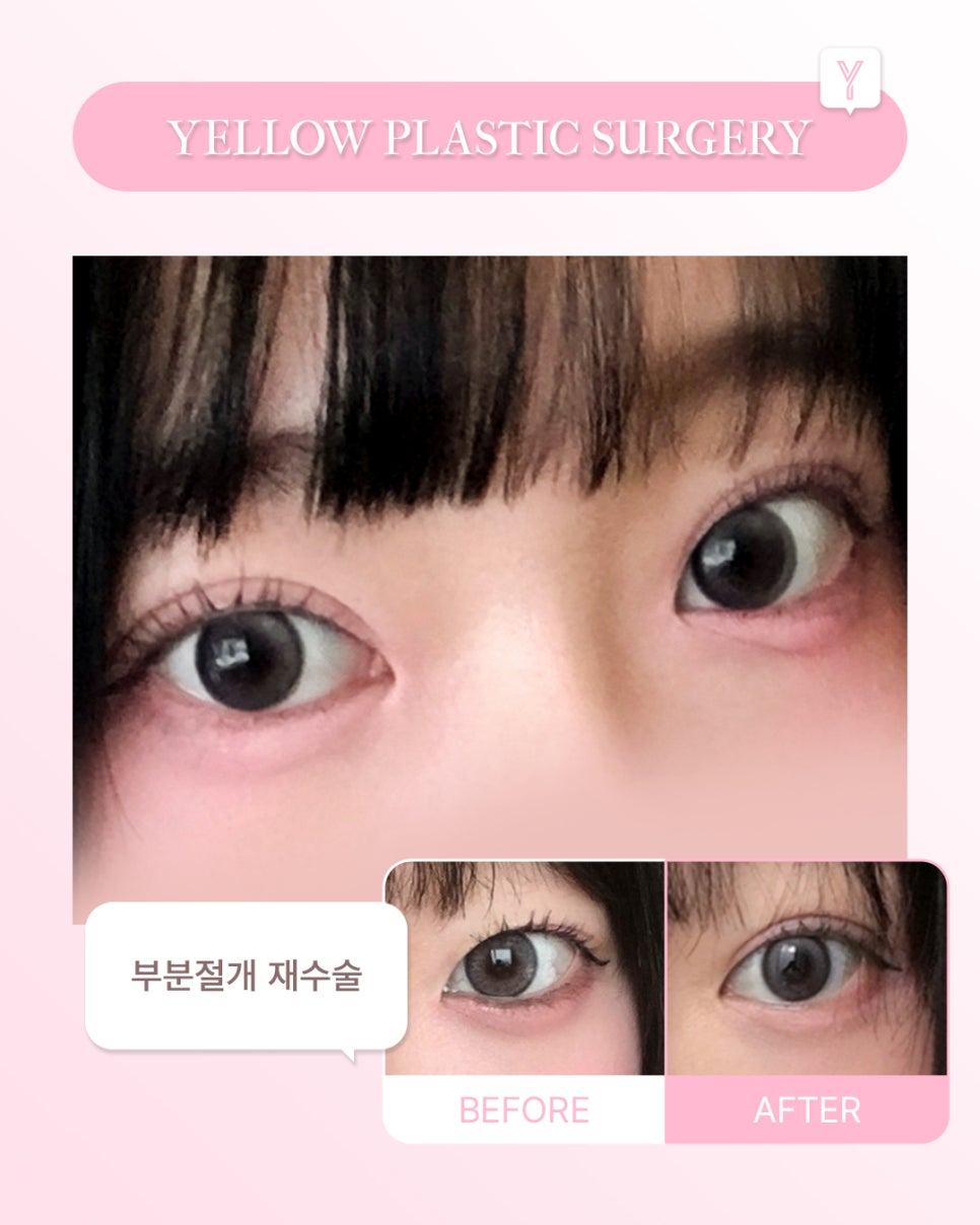 [ Gangnam Station Yellow Plastic Surgery / Eye Surgery ] Partial-Incision Revision Surgery image 1