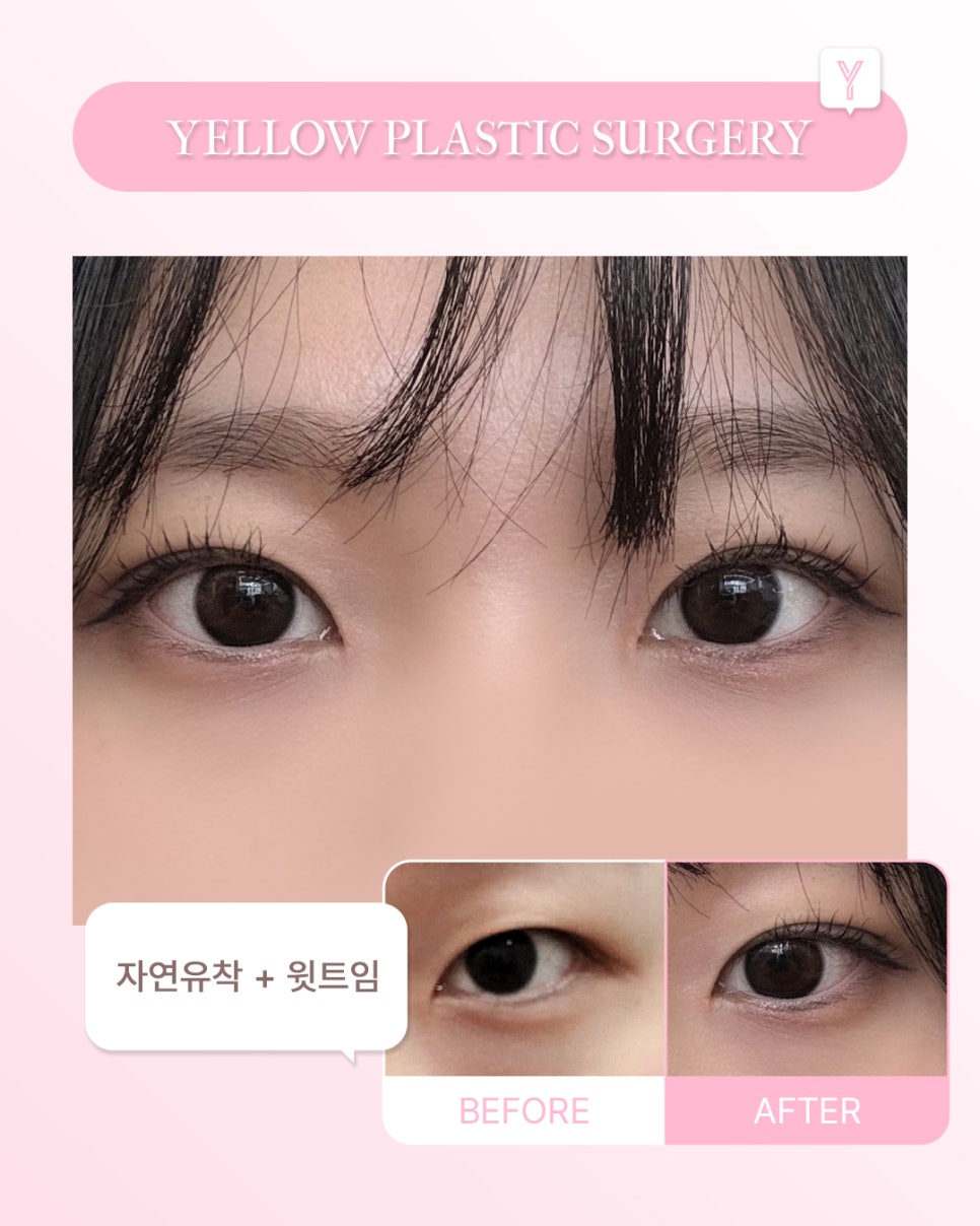 [ 강남역 옐로우성형외과 / 눈성형 ] 자연유착 + 윗트임 관련 이미지 1