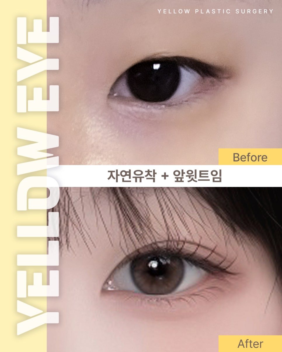 [ 강남역 옐로우성형외과 / 눈성형 ] 자연유착 + 앞윗트임 관련 이미지 1
