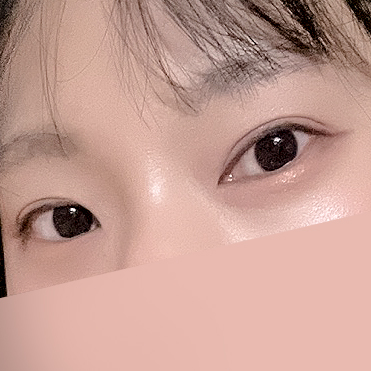 [ 강남역 옐로우성형외과 / 눈성형 ] 부분절개 재수술 후기 관련 이미지 9