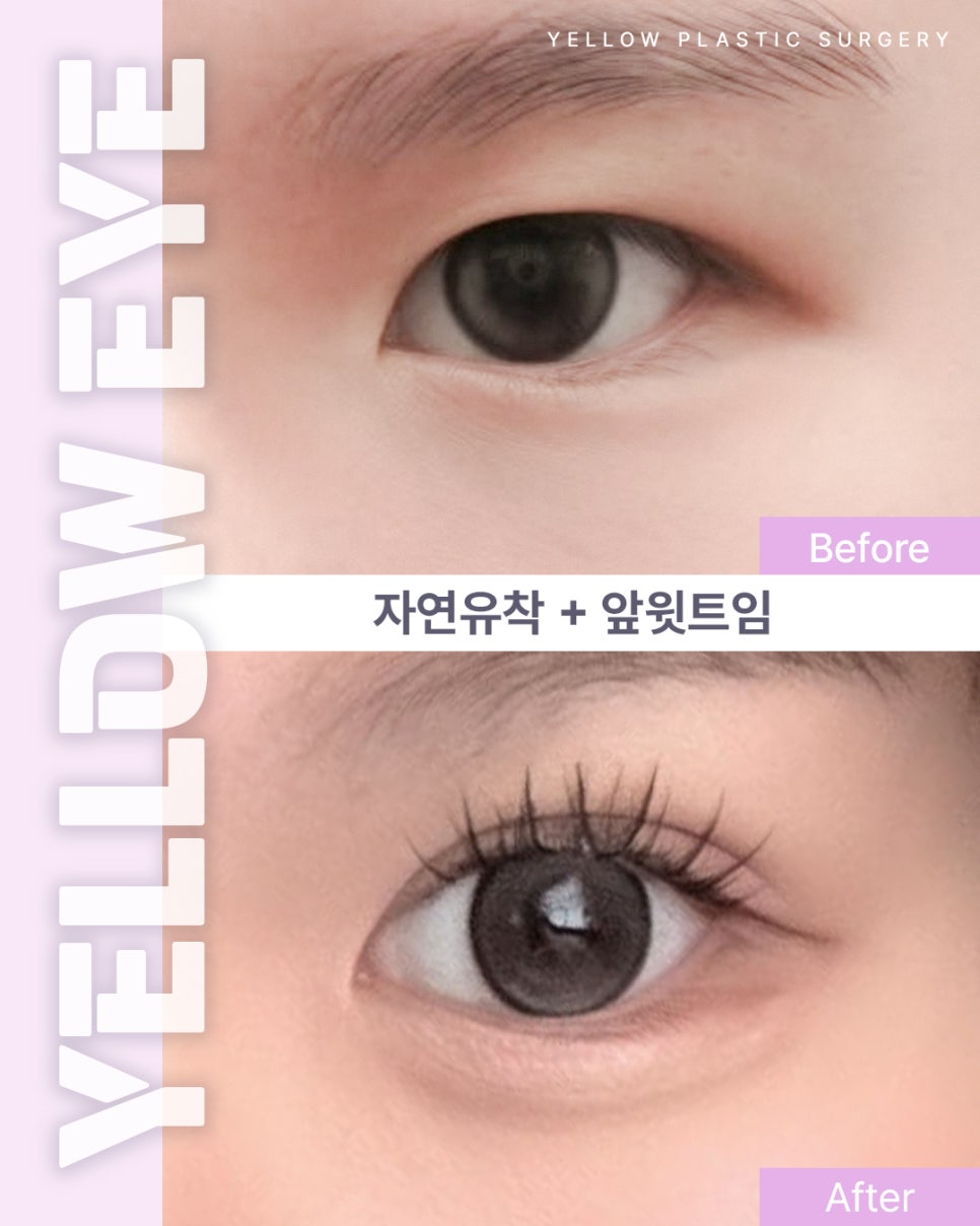 [Gangnam Station Yellow Plastic Surgery / Eye Plastic Surgery] Natural Adhesion + Upper Inner Canthoplasty image 1