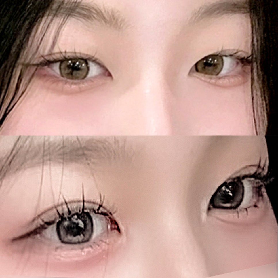 [ 강남역 옐로우성형외과 / 눈성형 ] 자연유착 윗트임 수술 후기 관련 이미지 1