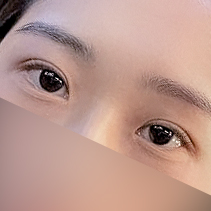 [ 강남역 옐로우성형외과 / 눈성형 ]  자연유착 눈수술 쌍수 후기 관련 이미지 6