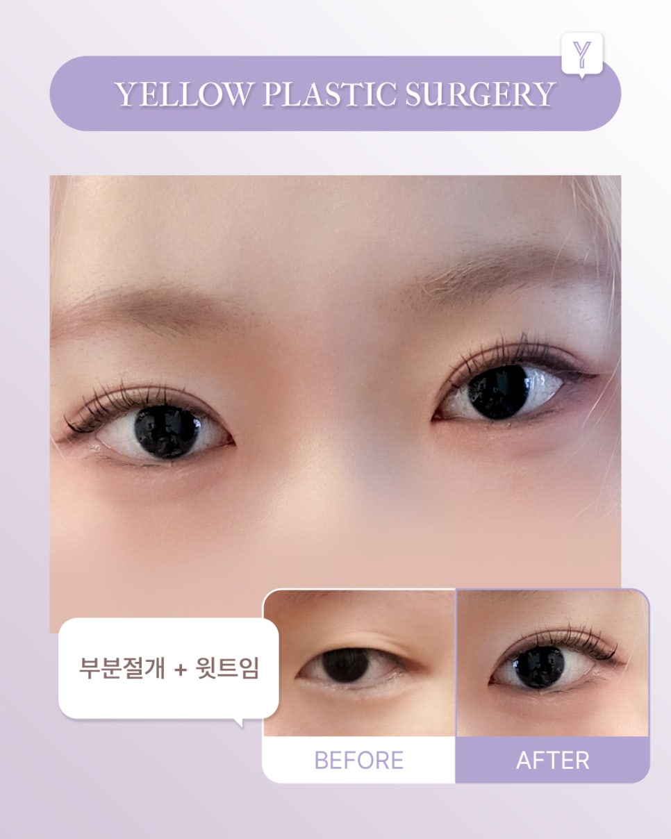 [ Gangnam Station Yellow Plastic Surgery / Eye Surgery ] Partial Incision + Upper Epicanthoplasty image 1