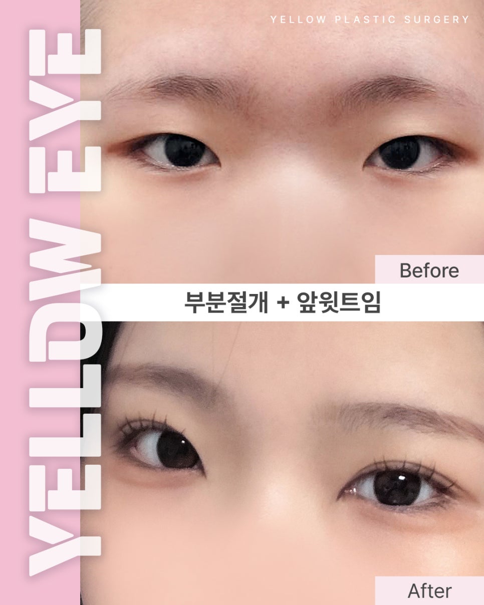 [ 강남역 옐로우성형외과 / 눈성형 ] 부분절개 + 앞윗트임 관련 이미지 1
