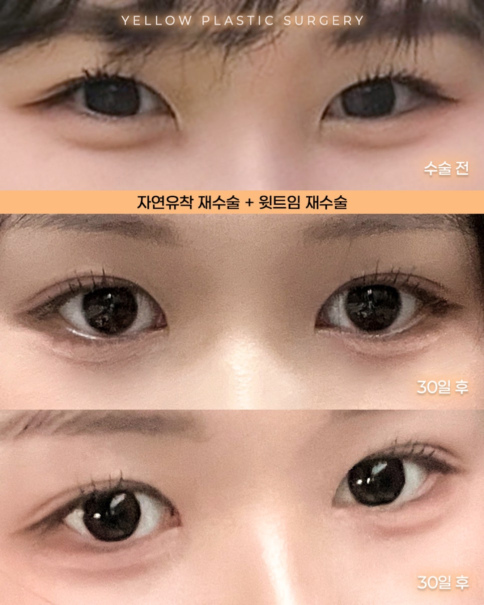 [ Gangnam Station Yellow Plastic Surgery / Eye Surgery ] Natural-Adhesion Revision + Revision Upper Canthoplasty image 1