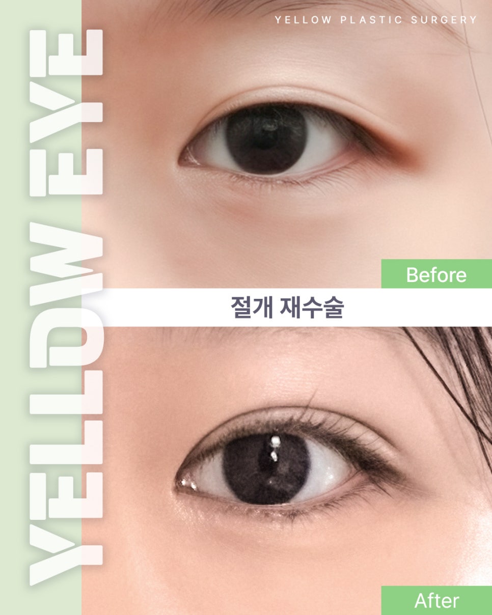 [ 강남역 옐로우성형외과 / 눈성형 ] 절개 재수술 관련 이미지 1