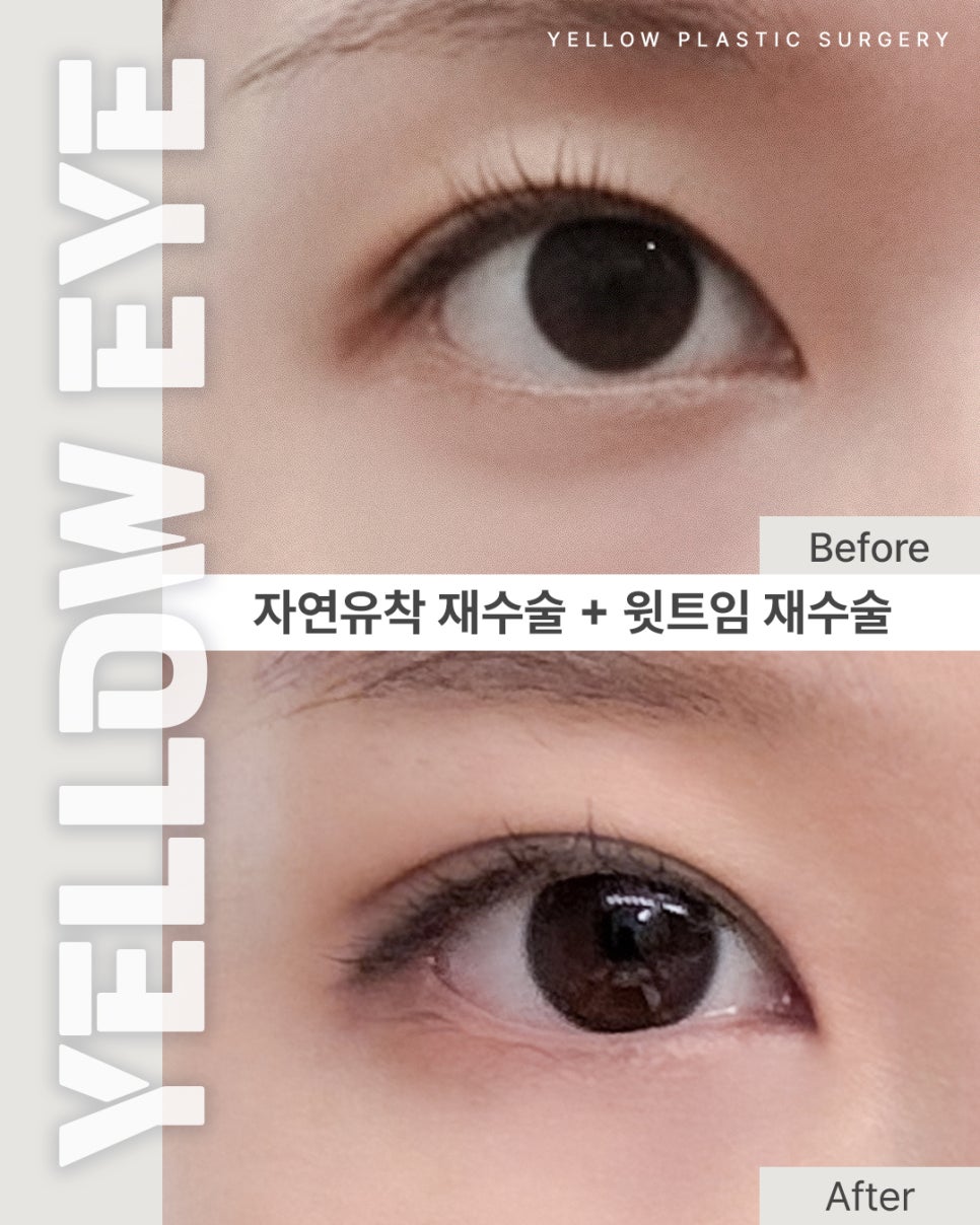[ 강남역 옐로우성형외과 / 눈성형 ] 자연유착 재수술 + 윗트임 재수술 관련 이미지 1