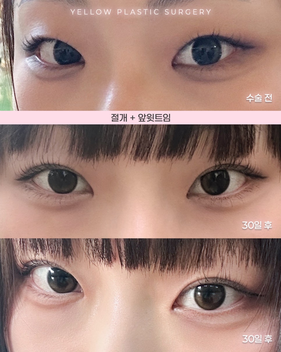 [ 강남역 옐로우성형외과 / 눈성형 ] 절개 + 앞윗트임 관련 이미지 1