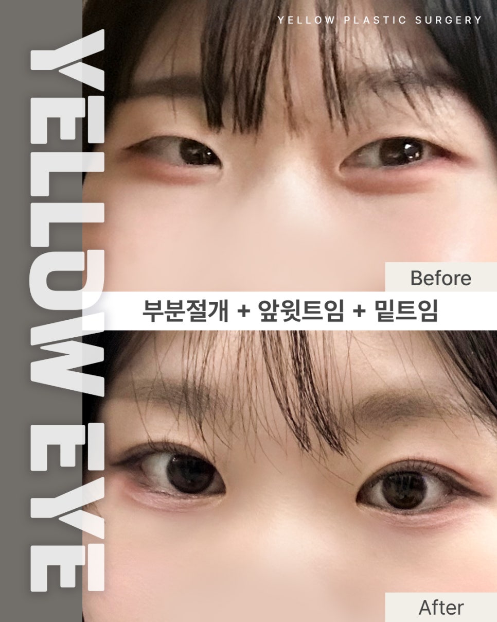 [ Gangnam Station Yellow Plastic Surgery / Eye Surgery ] Partial Incision + Medial and Upper Canthoplasty + Lower Canthoplasty image 1