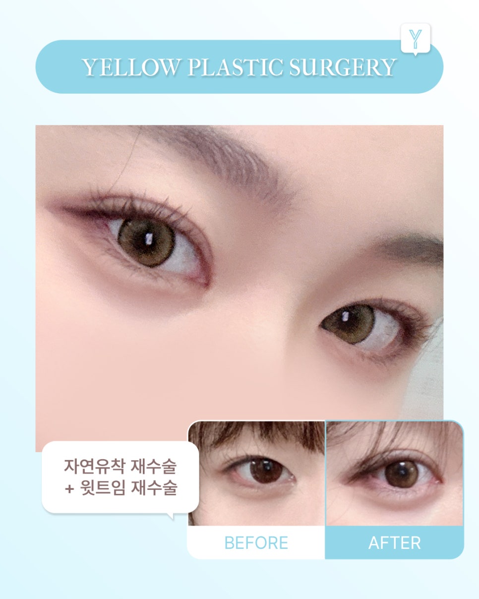 [ 강남역 옐로우성형외과 / 눈성형 ] 자연유착 재수술 + 윗트임 재수술 관련 이미지 1