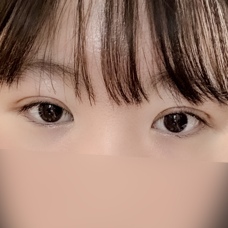 [ 강남역 옐로우성형외과 / 눈성형 ]  부분절개 앞트임 윗트임 수술 후기 2개월차 4개월차 관련 이미지 3