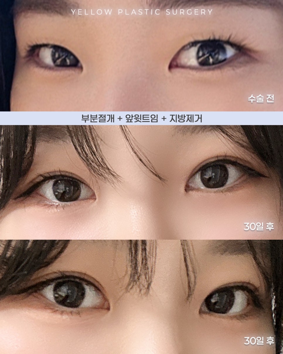 [ Gangnam Station Yellow Plastic Surgery Clinic / Eye Surgery ] Partial Incision + Inner and Upper Canthoplasty + Fat Removal image 1
