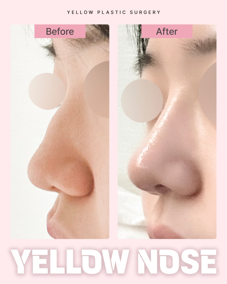 [ Gangnam Station Yellow Plastic Surgery / Rhinoplasty ] image 1