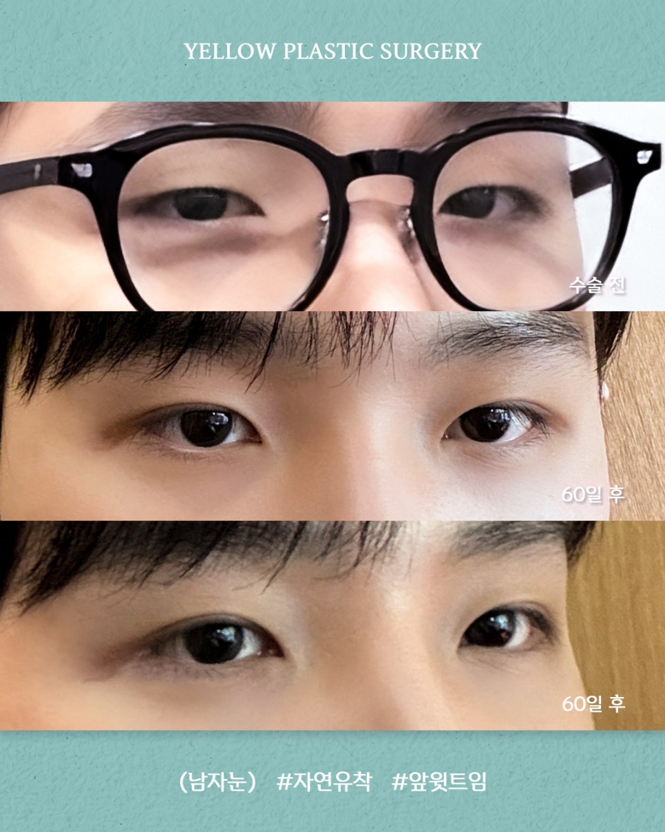 [ 강남역 옐로우성형외과 / 눈성형 ] (남자눈) 자연유착 + 앞윗트임 관련 이미지 1