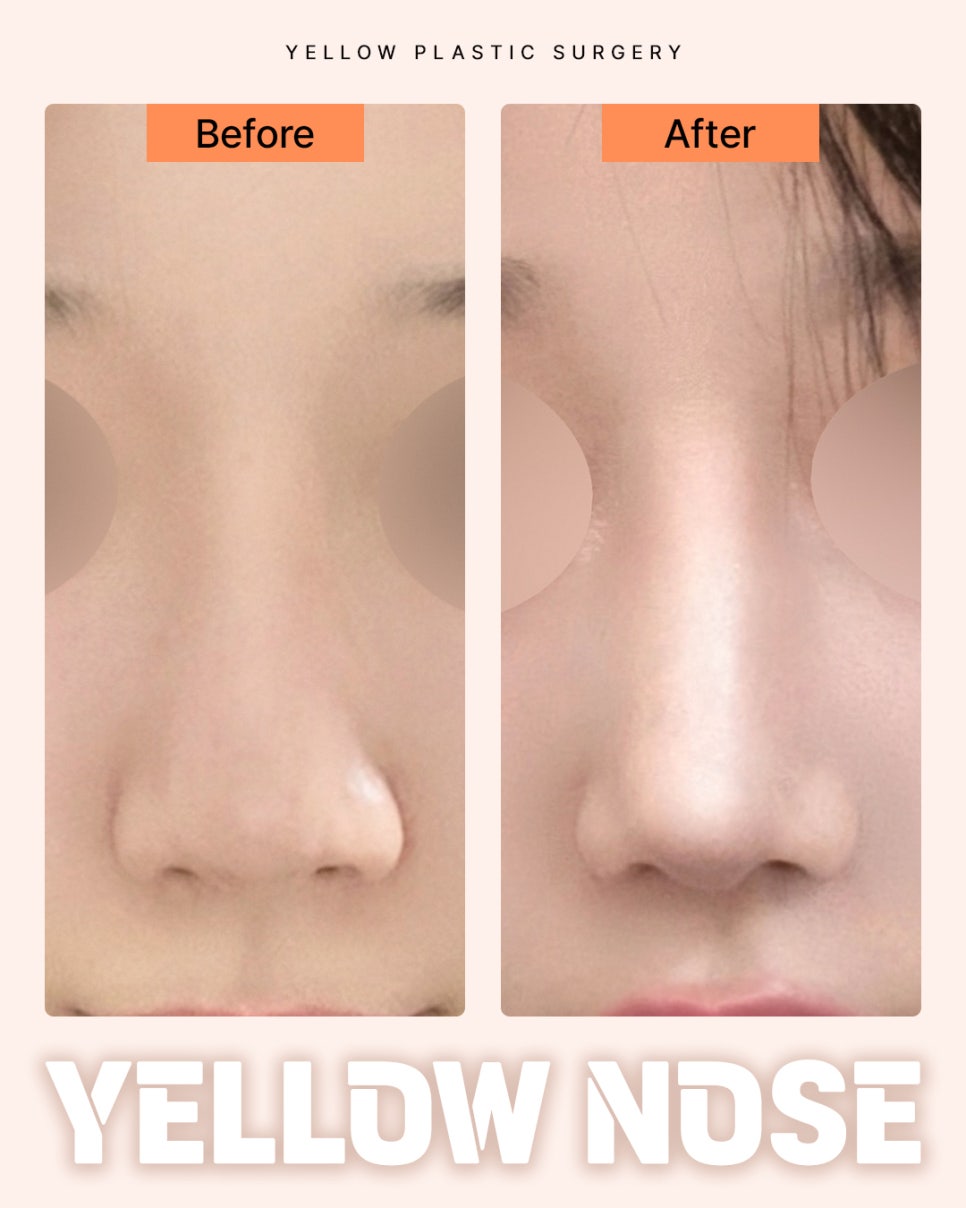 Gangnam Station Yellow Plastic Surgery / Rhinoplasty image 1