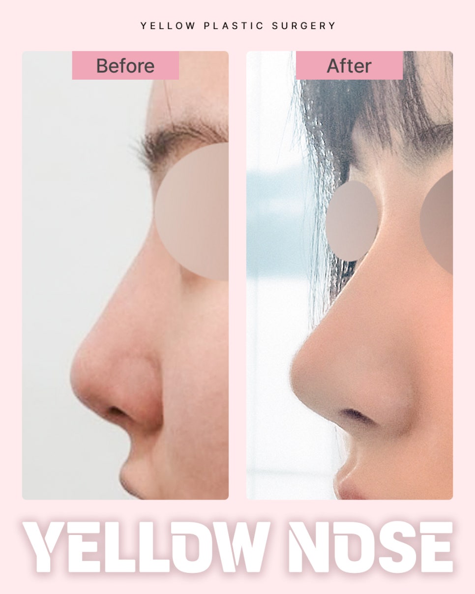 [ Gangnam Station Yellow Plastic Surgery Clinic / Rhinoplasty ] image 1