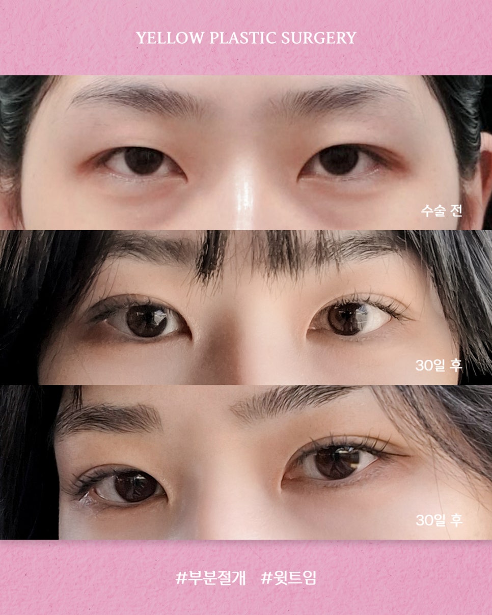 [ 강남역 옐로우성형외과 / 눈성형 ] 부분절개 + 윗트임 관련 이미지 1