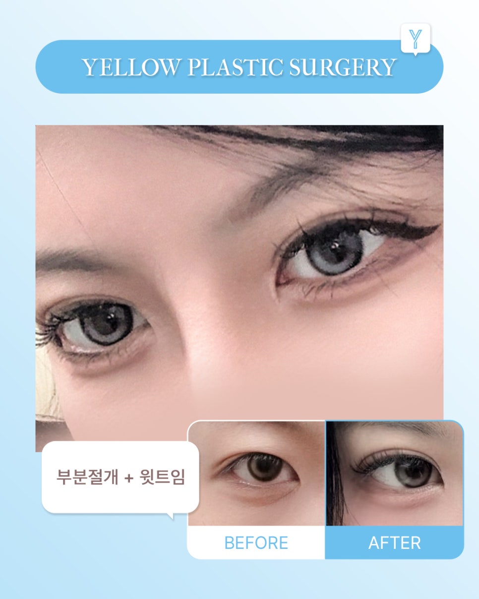 [ Gangnam Station Yellow Plastic Surgery / Eye Surgery ] Partial Incision + Upper Epicanthoplasty image 1