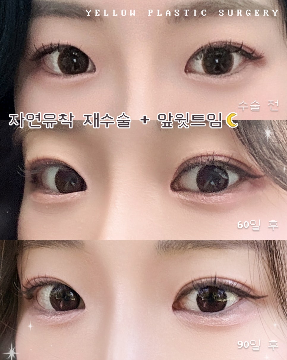 [Gangnam Station Yellow Plastic Surgery / Eye Surgery] Revision Surgery for Natural Adhesion + Front Upper Eyepit Opening image 1