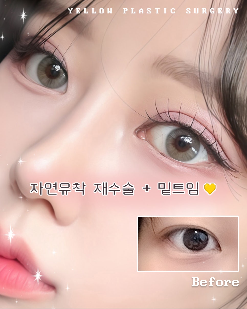 [ 강남역 옐로우성형외과 / 눈성형 ] 자연유착 재수술 + 밑트임 관련 이미지 1