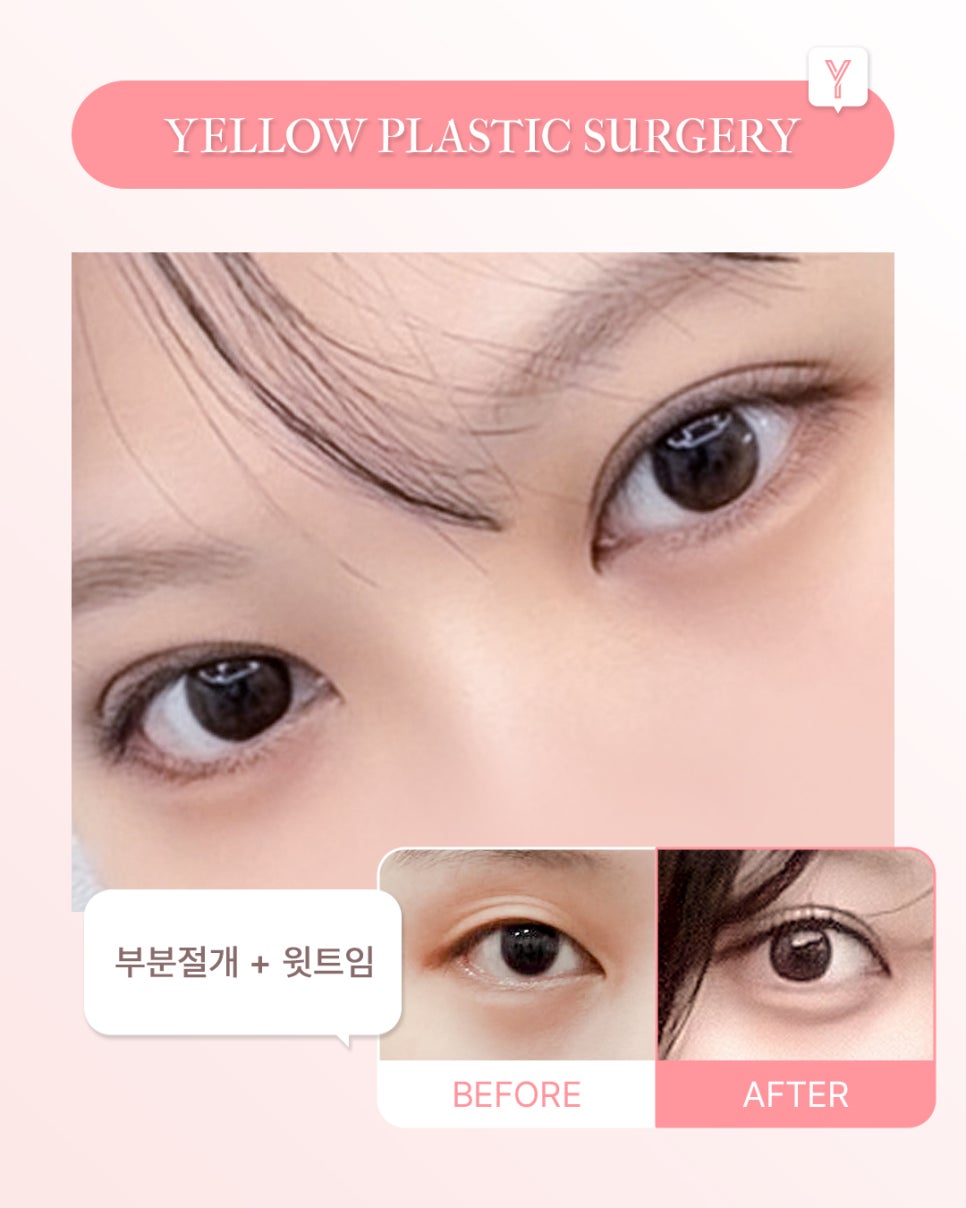 [ 강남역 옐로우성형외과 / 눈성형 ] 부분절개 + 윗트임 관련 이미지 1
