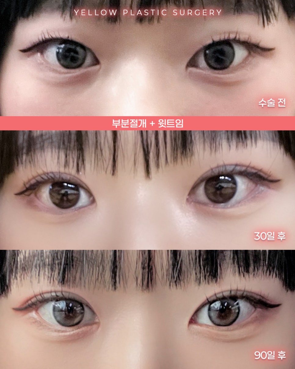 [ Gangnam Station Yellow Plastic Surgery / Eye Surgery ] Partial Incision + Upper Canthoplasty image 1