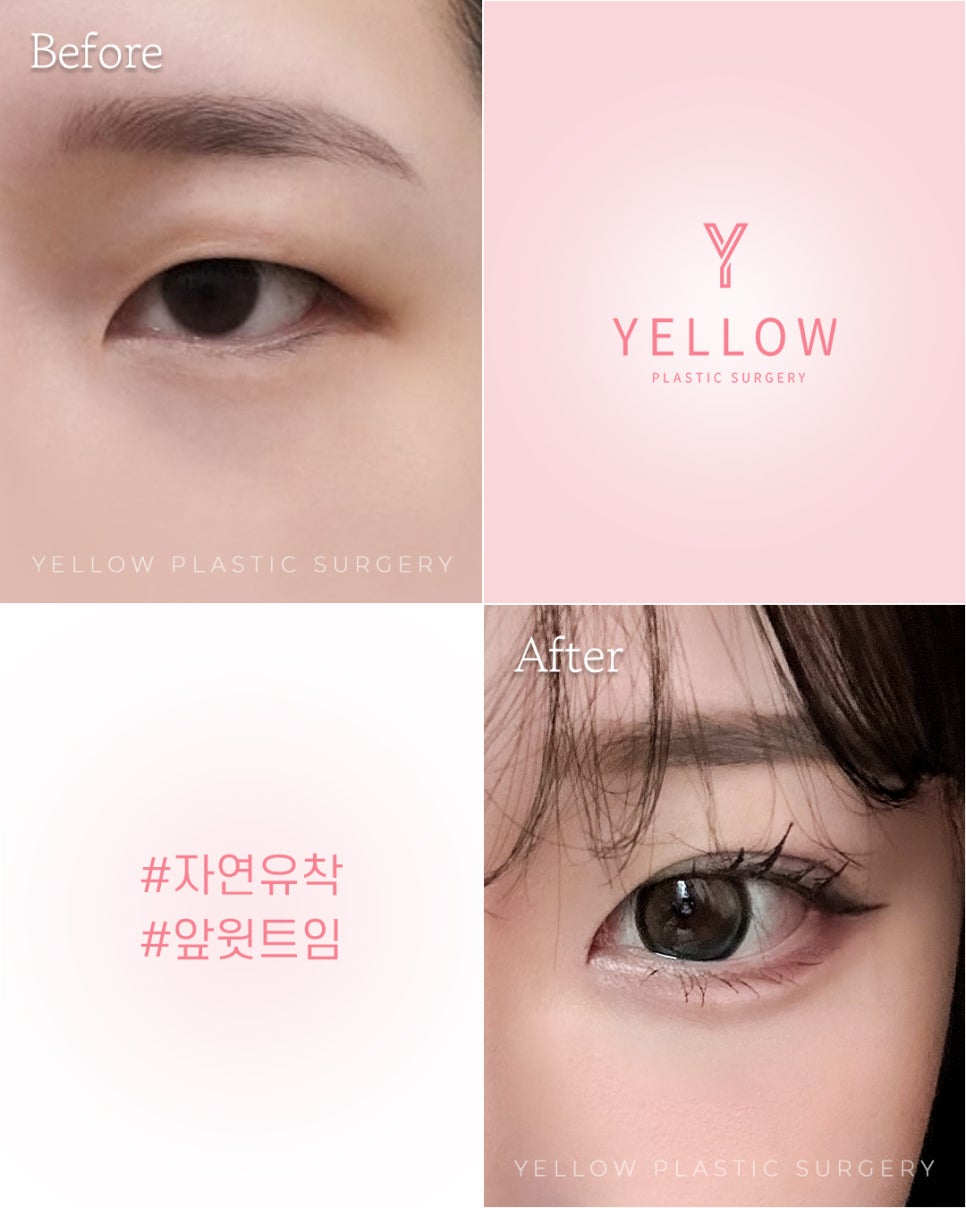 [ 강남역 옐로우성형외과 / 눈성형 ] 자연유착 + 앞윗트임 관련 이미지 1