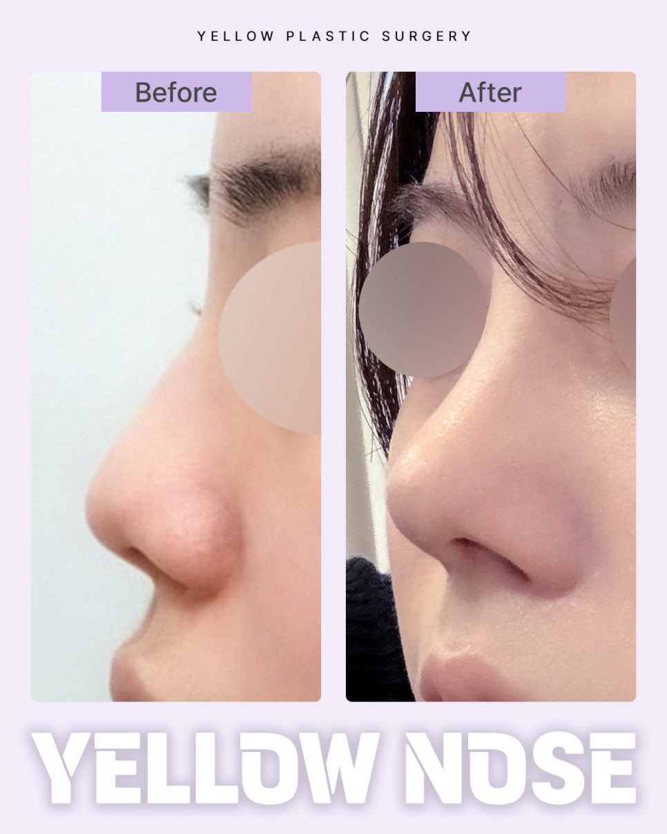 Gangnam Station Yellow Plastic Surgery / Rhinoplasty image 1