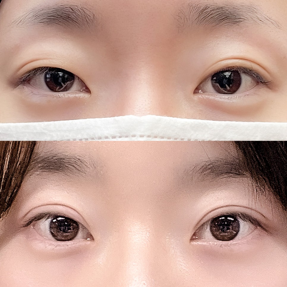 [Gangnam Station Yellow Plastic Surgery / Eye Surgery] Seven-Month Review After First Partial Incision Surgery: Improvement in Uneven Eyes image 1