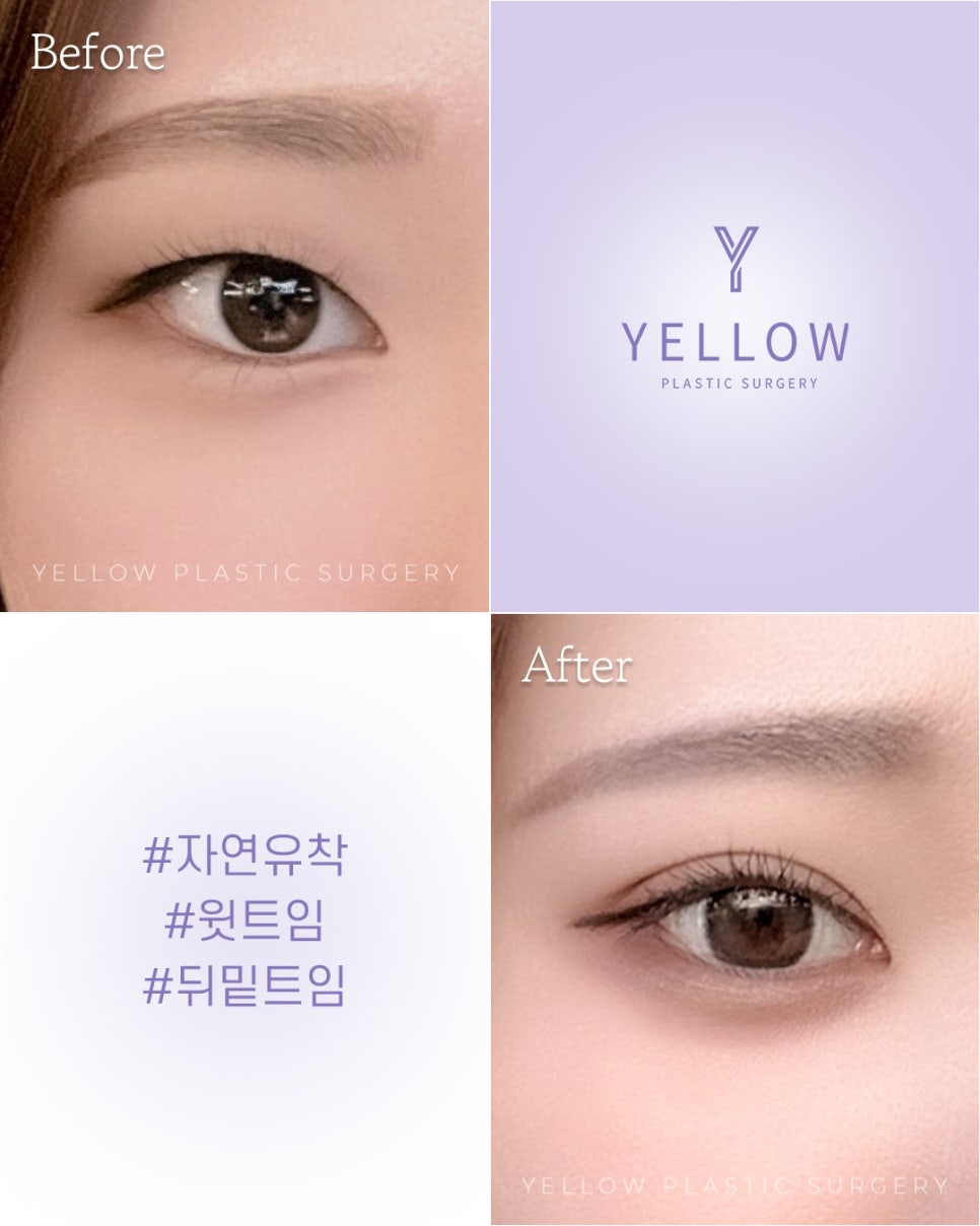 [ Gangnam Station Yellow Plastic Surgery / Eye Surgery ] Natural Adhesion + Upper Epicanthoplasty + Outer Lower Canthoplasty image 1