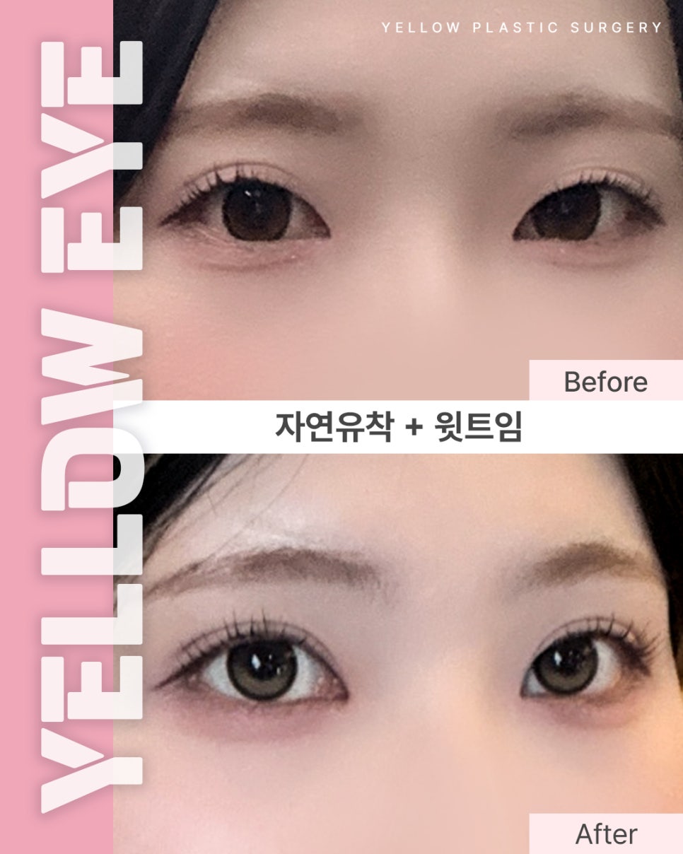 [ 강남역 옐로우성형외과 / 눈성형 ] 자연유착 + 윗트임 관련 이미지 1