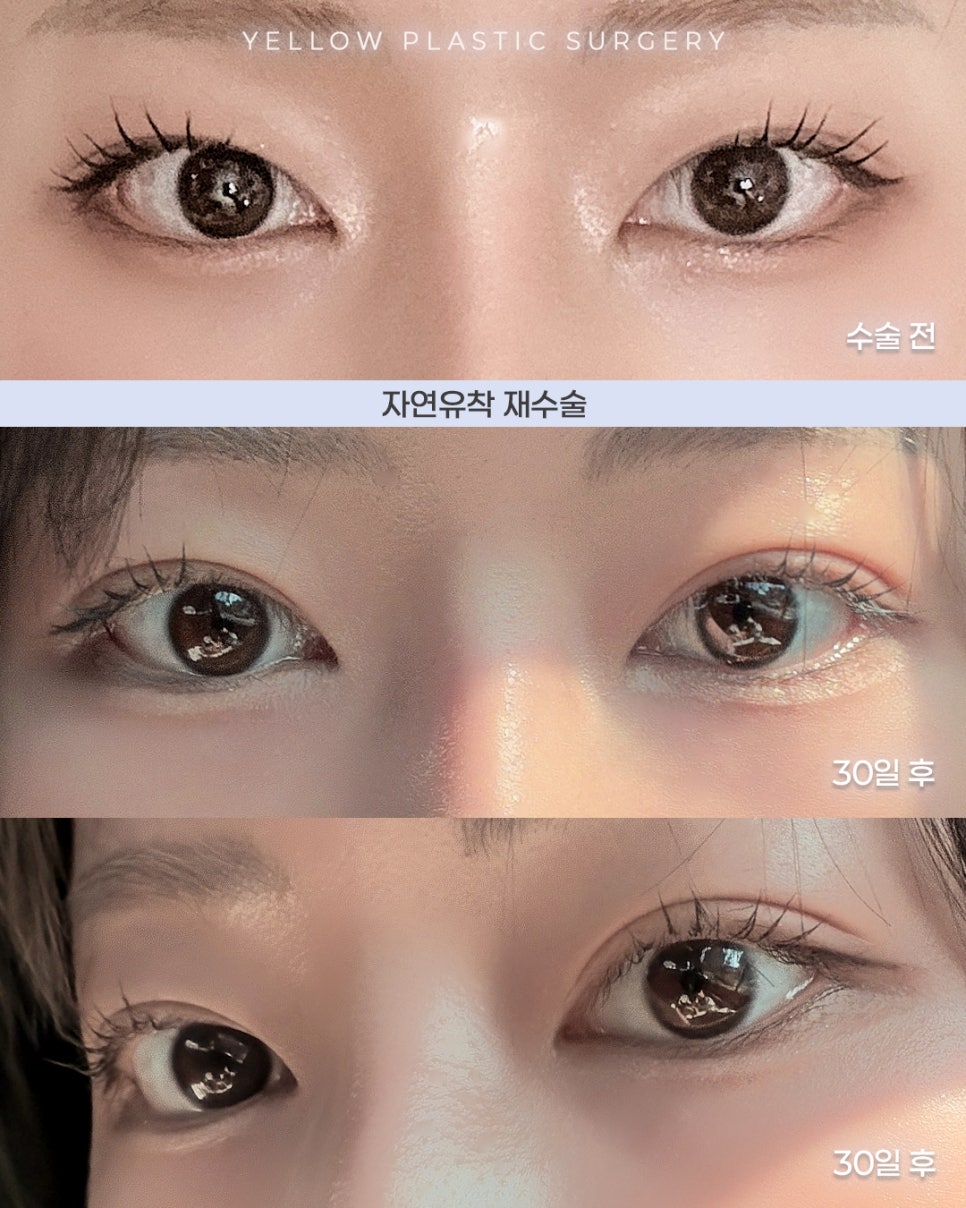 [ 강남역 옐로우성형외과 / 눈성형 ] 자연유착 재수술 관련 이미지 1