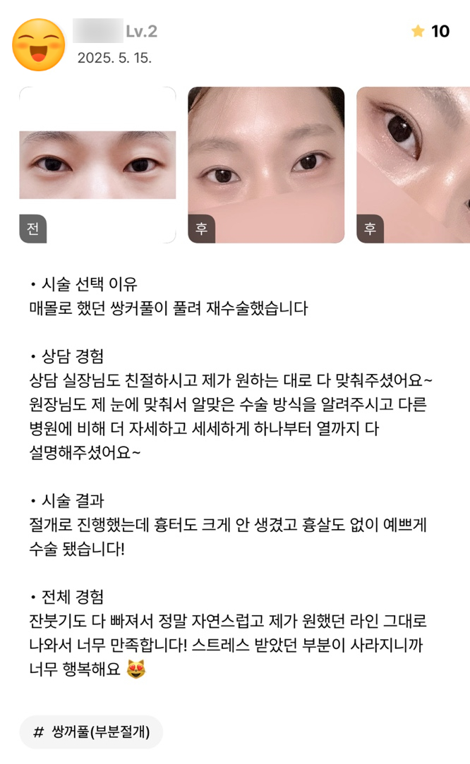 [ 강남역 옐로우성형외과 / 눈성형 ] 부분절개 재수술 후기 관련 이미지 2