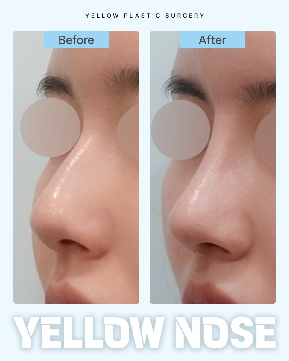 Gangnam Station Yellow Plastic Surgery / Nose Surgery image 1