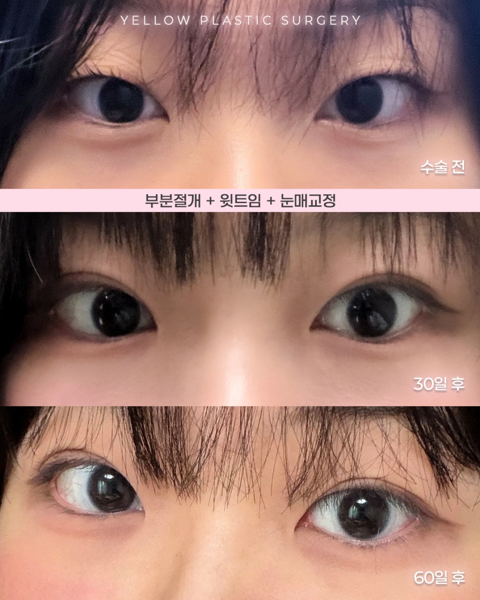 [ 강남역 옐로우성형외과 / 눈성형 ] 부분절개 + 윗트임 + 눈매교정 관련 이미지 1