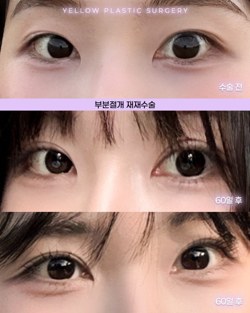 [ Gangnam Station Yellow Plastic Surgery / Eye Surgery ] Partial-Incision Revision Surgery, Second Revision image 1