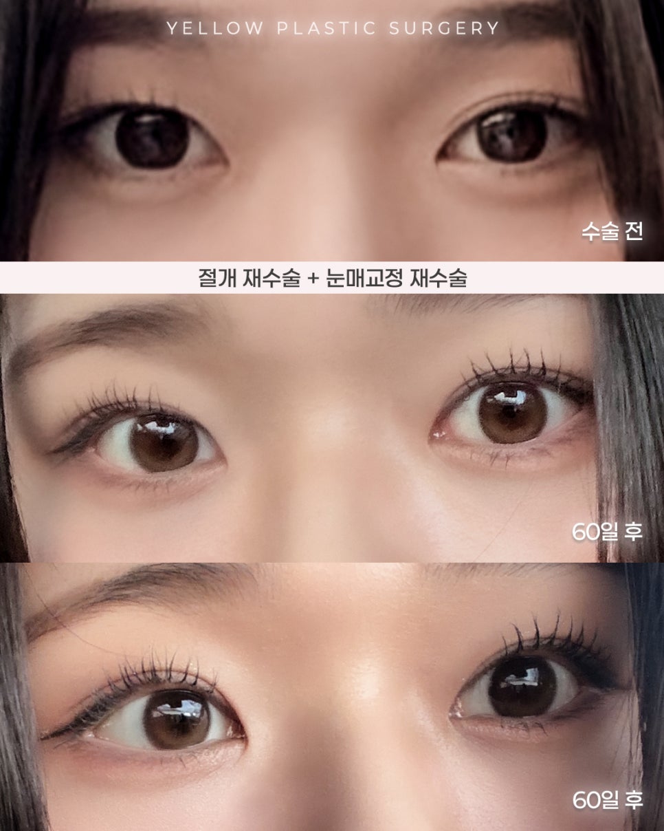 [ 강남역 옐로우성형외과 / 눈성형 ] 절개 재수술 + 눈매교정 재수술 관련 이미지 1