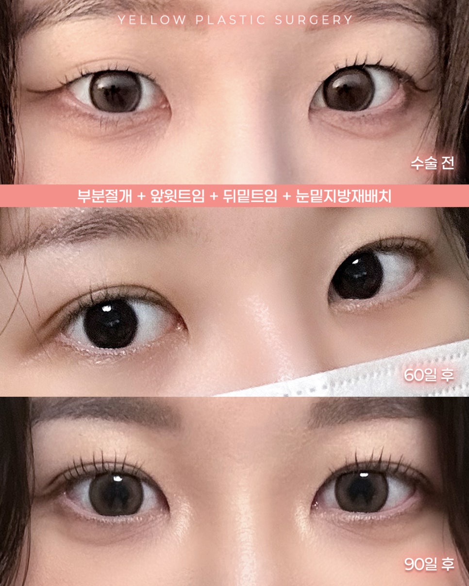 [ 강남역 옐로우성형외과 / 눈성형 ] 부분절개 + 앞윗트임 + 뒤밑트임 + 눈밑지방재배치 관련 이미지 1