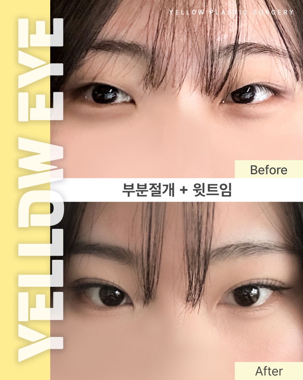 [ 강남역 옐로우성형외과 / 눈성형 ] 부분절개 + 윗트임 관련 이미지 1