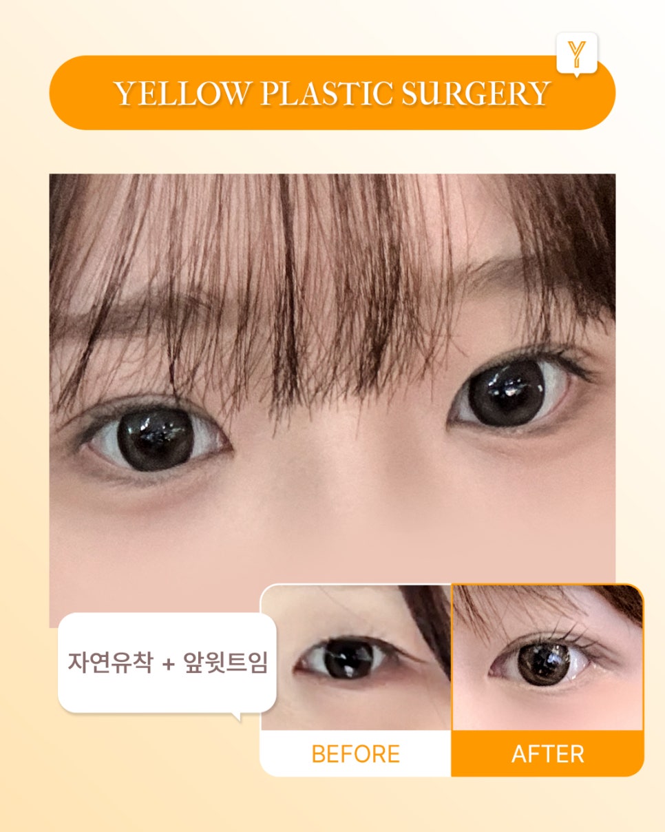 [ 강남역 옐로우성형외과 / 눈성형 ] 자연유착 + 앞윗트임 관련 이미지 1