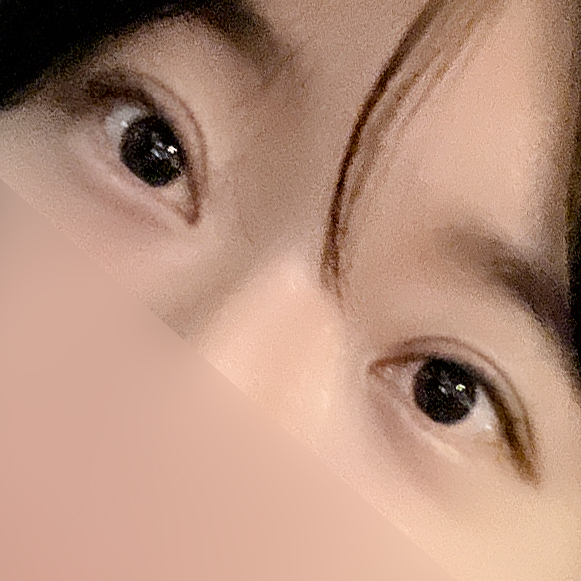 [Gangnam Station Yellow Plastic Surgery / Eye Surgery] Seven-Month Review After First Partial Incision Surgery: Improvement in Uneven Eyes image 6